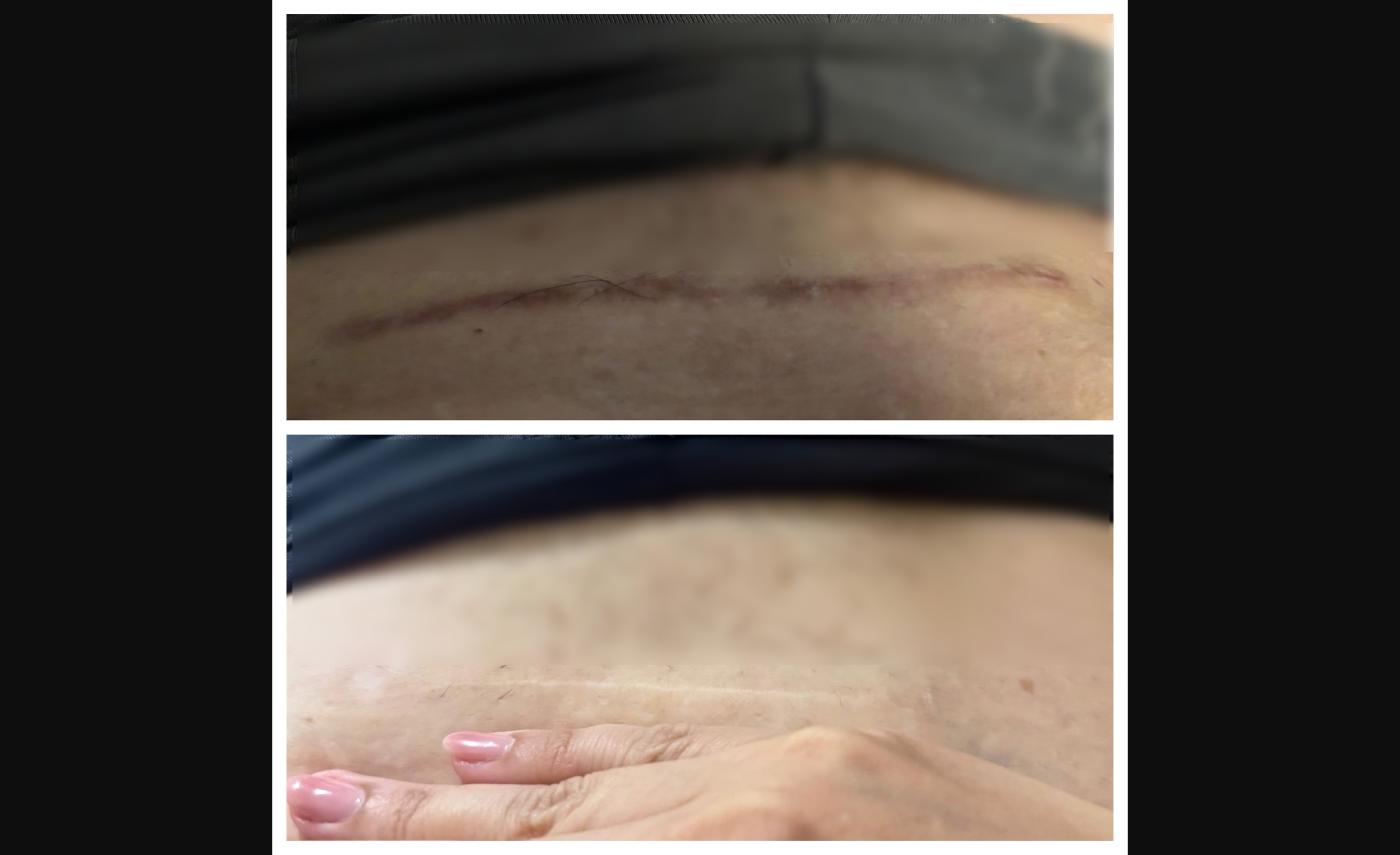 Keloid scar before and after collage