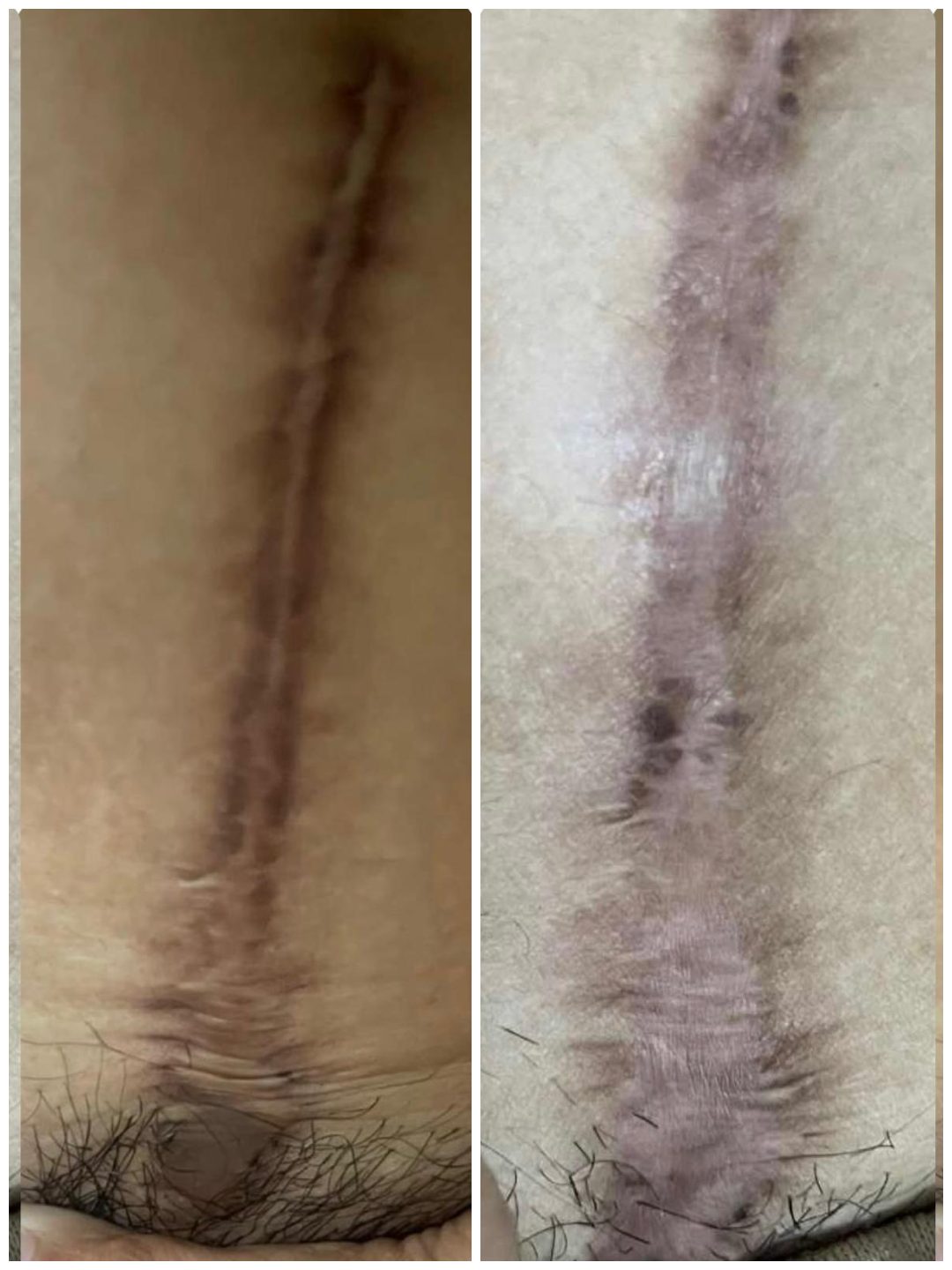 Keloid scar before and after second patient